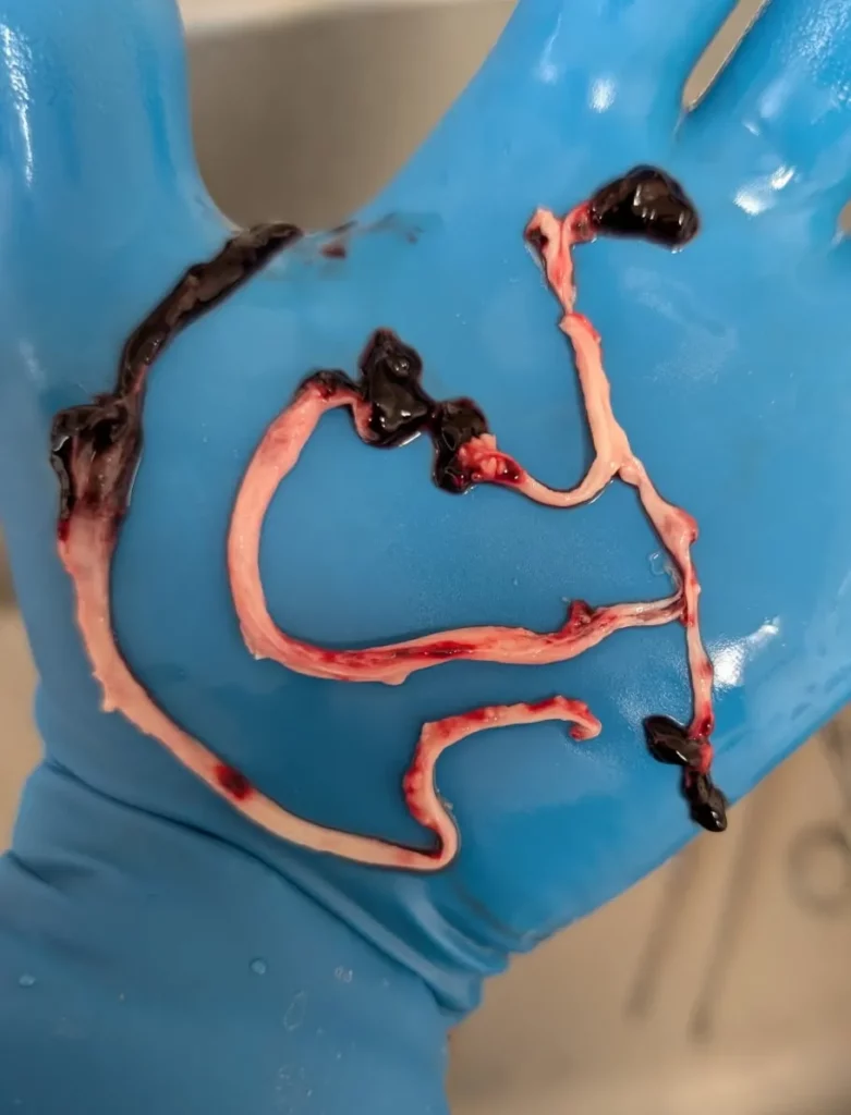 Bloodclots2